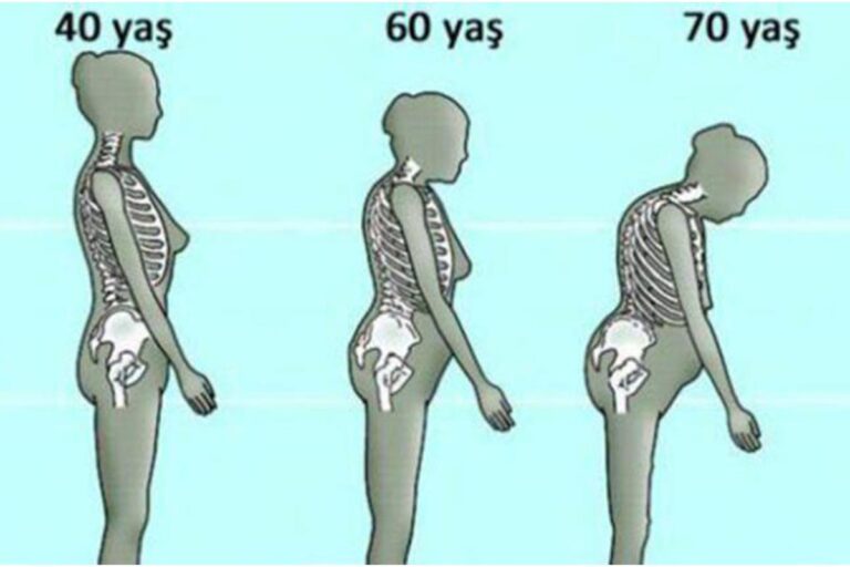 osteoporoz, kemik erimesi